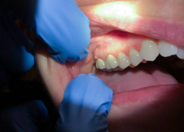 Best Emergency Tooth Extraction in Crosby, TX